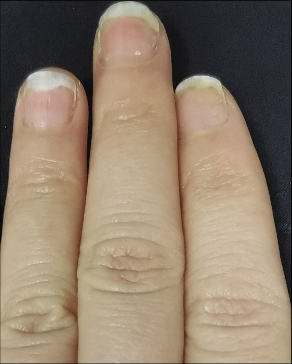 Intramatricial low-dose secukinumab injection for nail psoriasis ...