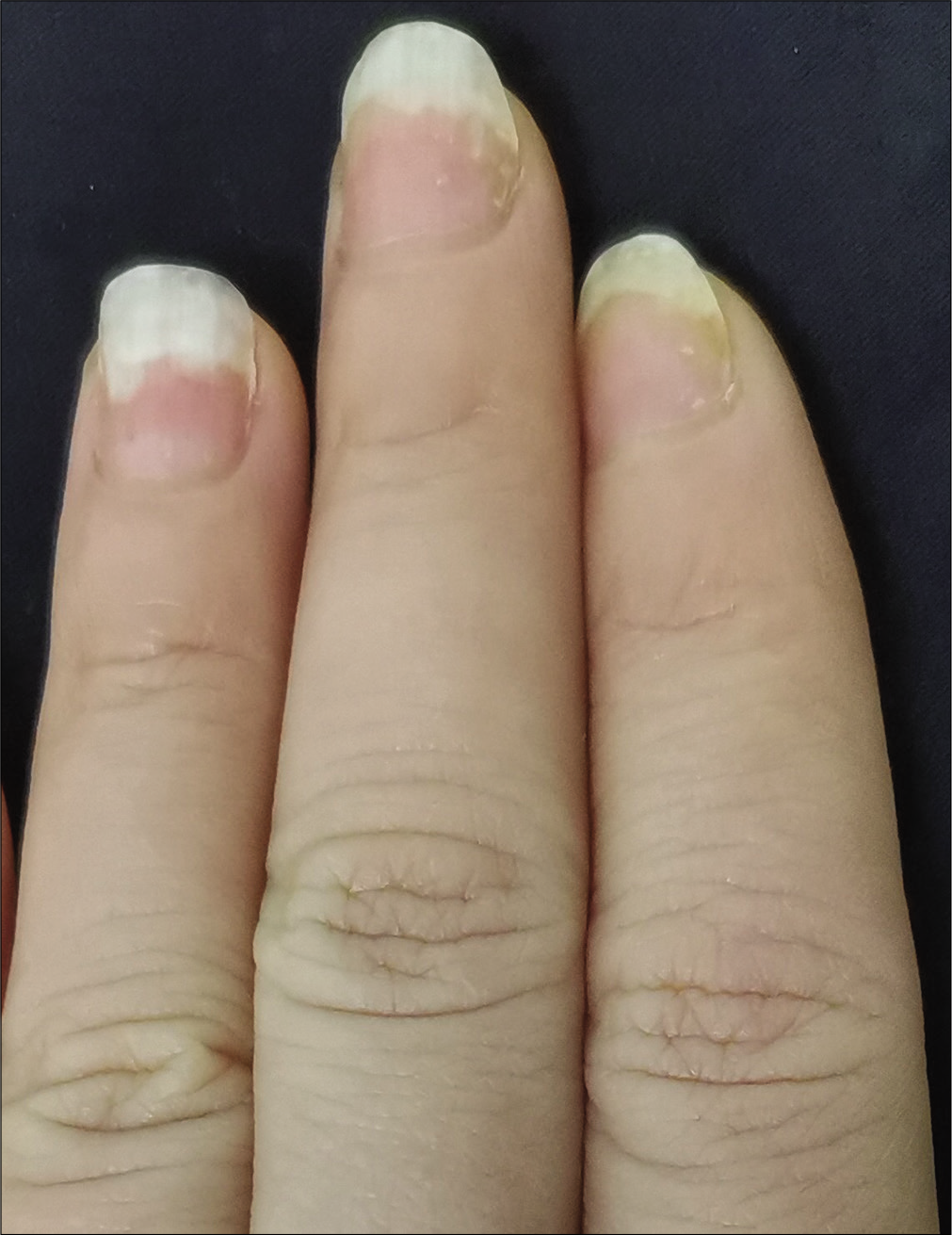 Intramatricial low-dose secukinumab injection for nail psoriasis ...