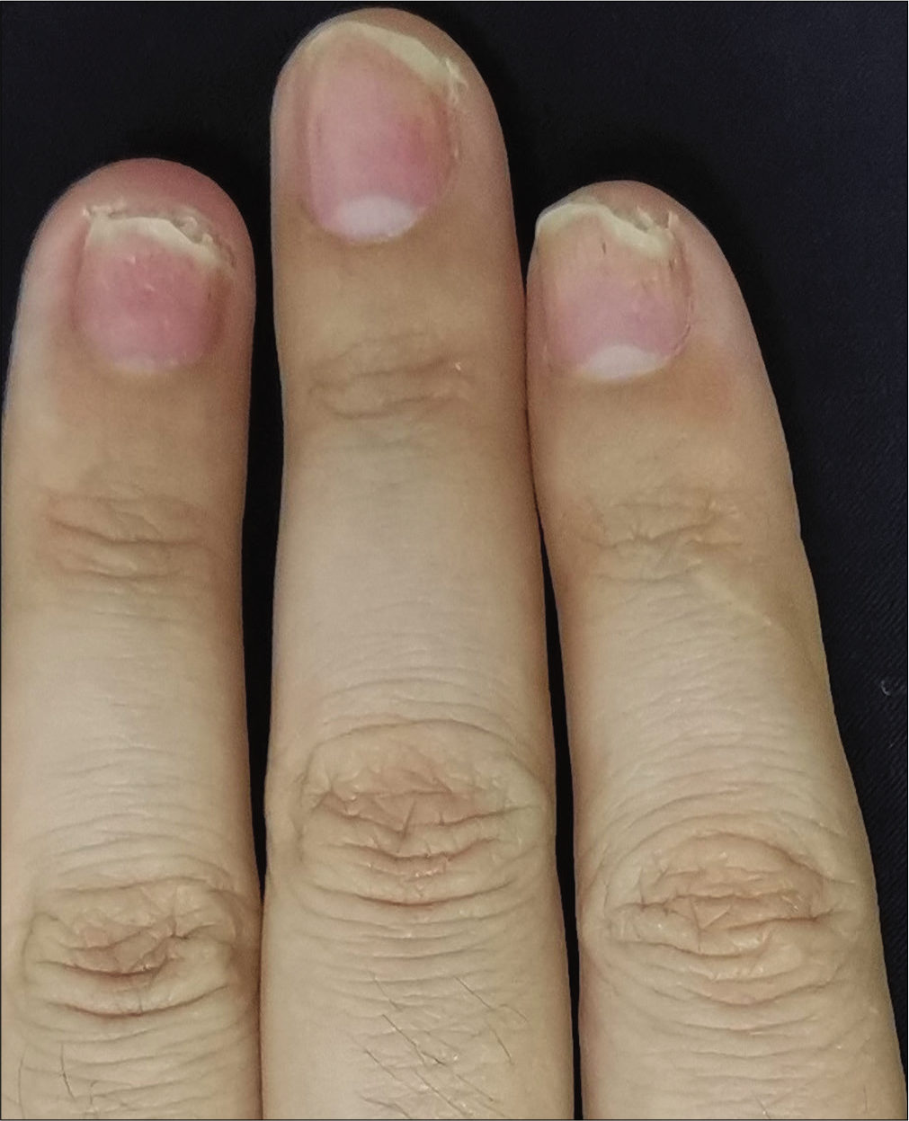 Intramatricial low-dose secukinumab injection for nail psoriasis ...