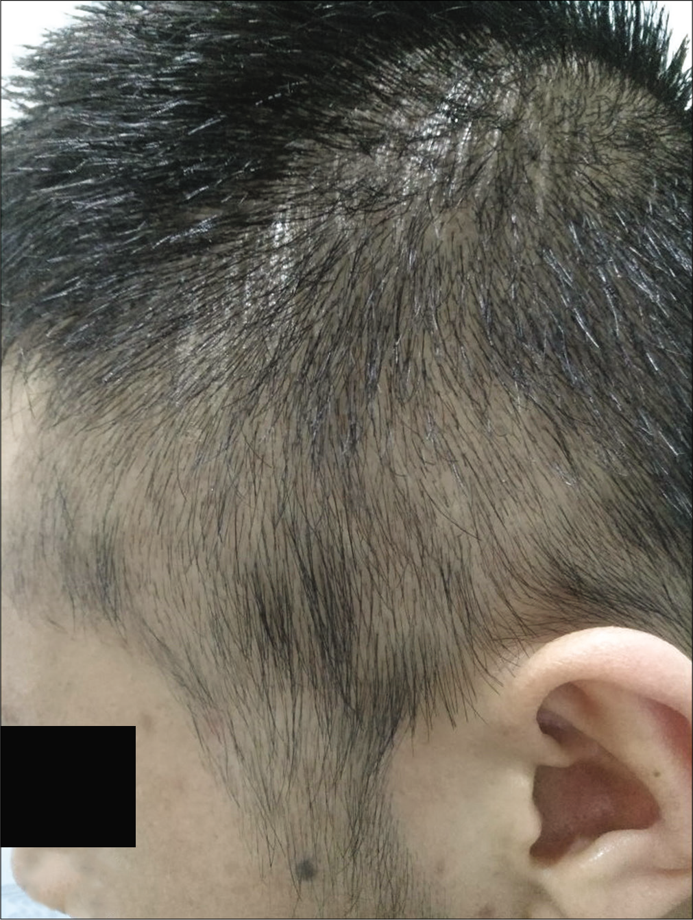 folliculitis hair loss