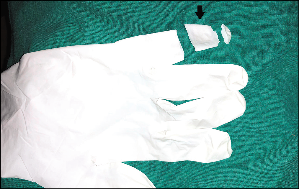 A finger of an easily available sterile or unsterile glove can be cut as shown