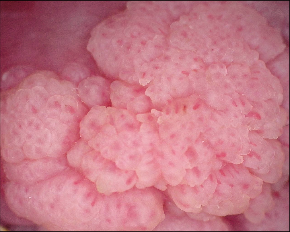 Genitodermoscopy showing the knoblike pattern with few finger-like projections in a genital wart. Note the hairpin vessels in the projections (Dinolite AM413ZT; ×50; polarising)