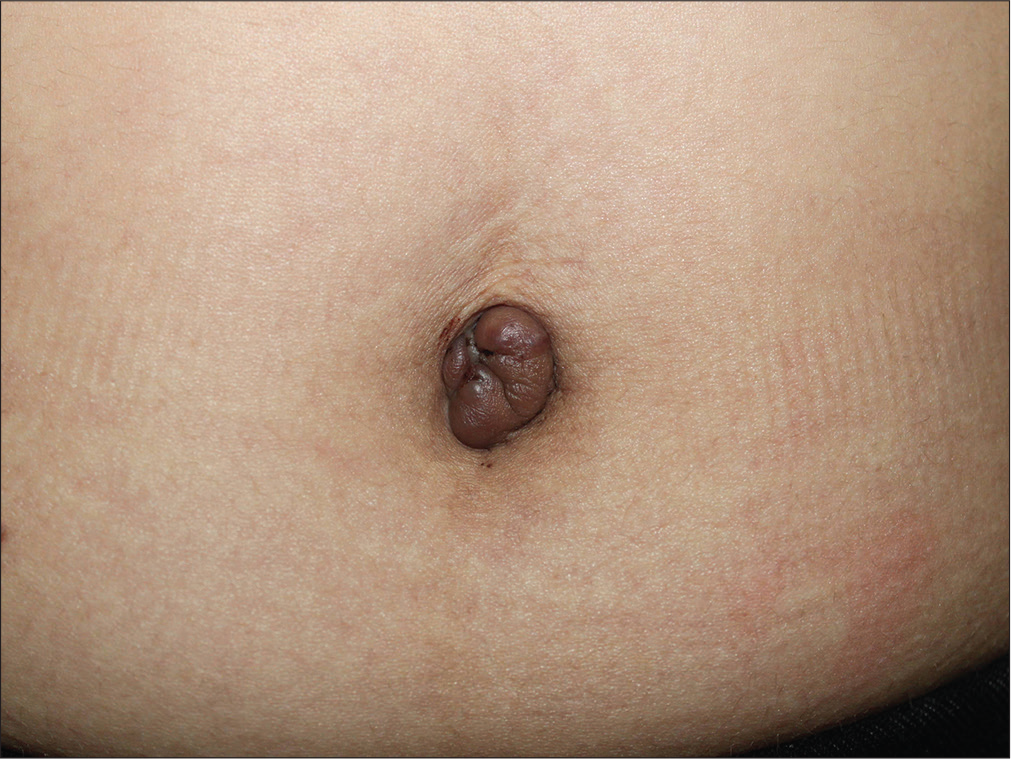 Menstruating primary umbilicus cutaneous endometriosis: A case