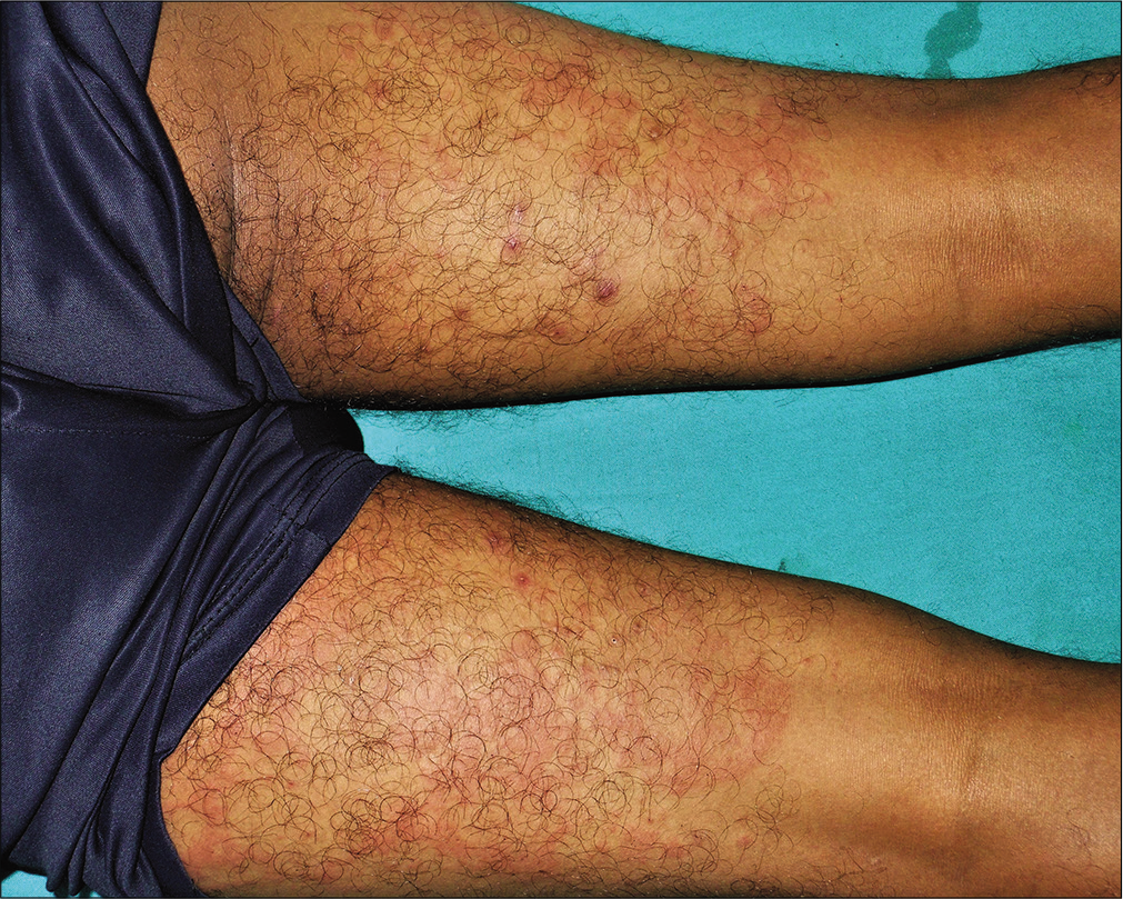 Multiple tender, annular and arciform, partially blanchable, erythematous plaques distributed over the posterior aspects of both thighs