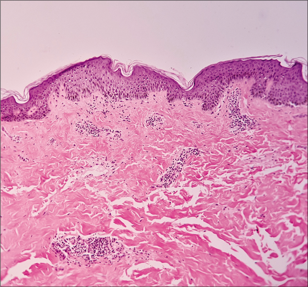 Acanthosis, dermal edema, and perivascular inflammatory cell infiltrate in papillary dermis (H and E, ×100)