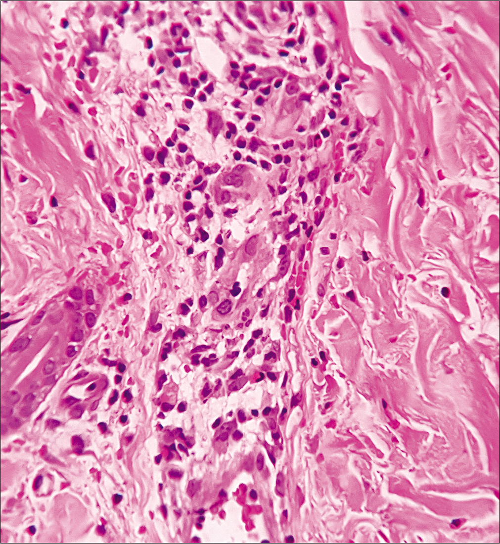 Lymphocytic, neutrophilic and few eosinophilic infiltrations of the vessel wall with endothelial cell damage, and erythrocyte extravasation suggestive of urticarial vasculitis. (H and E, ×400)