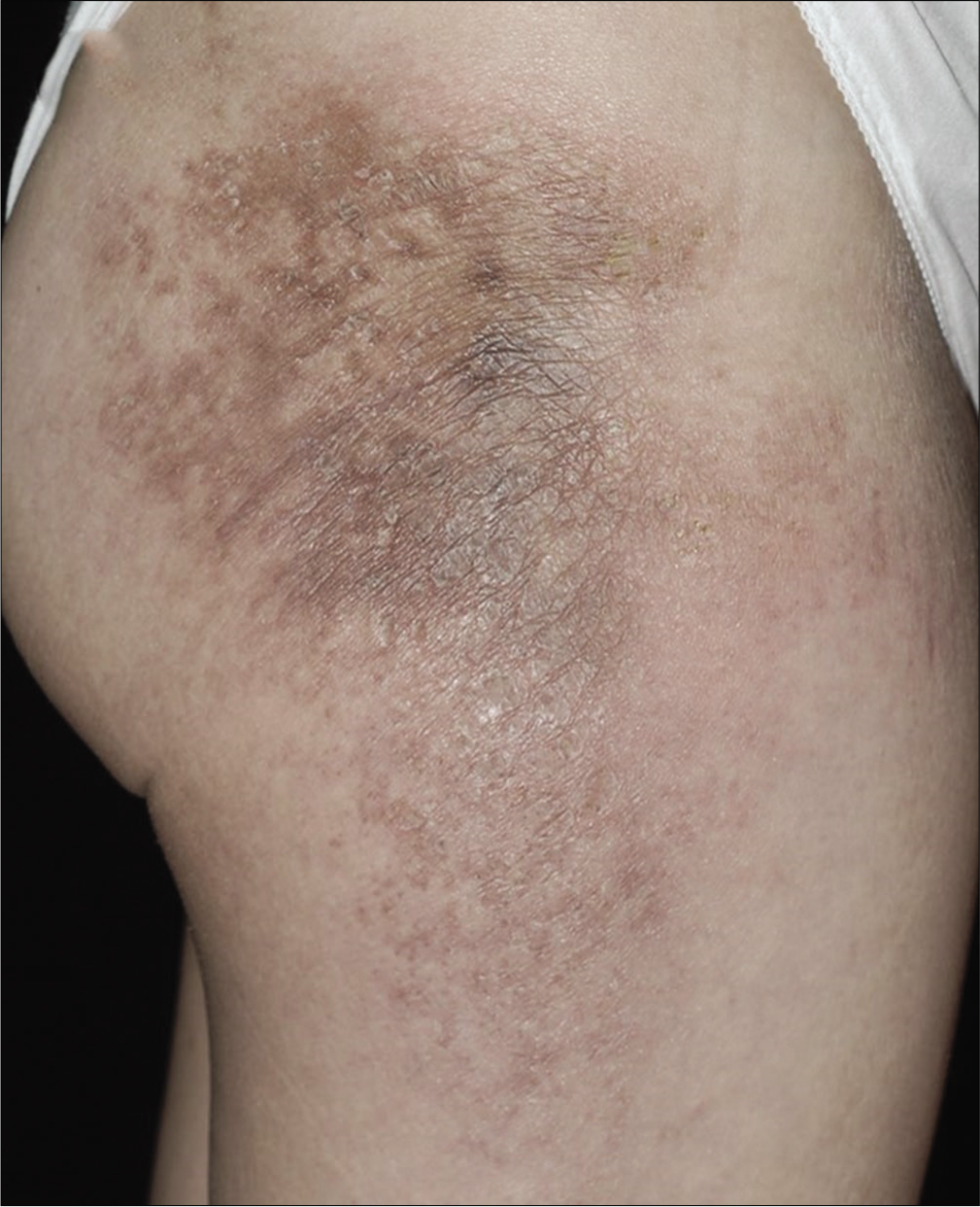 Brownish indurated plaque with peripheral erythema on the posterolateral aspect of the right thigh