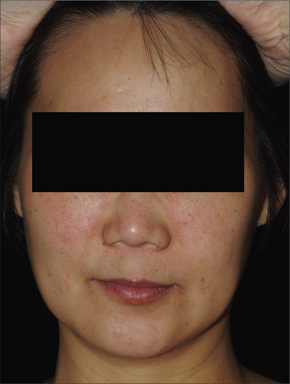 Malar rash was noted on bilateral cheeks