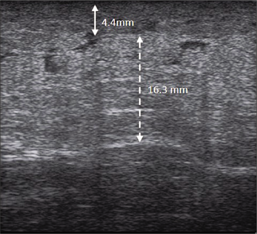 Ultrasonographic image showing thickened dermis and subcutaneous layer, and homogenously hyperechoic subcutis with a cloudy appearance. The thickness of the dermis and the subcutaneous layer was 4.4 mm (solid double arrow line) and 16.3 mm (dotted double arrow line), respectively