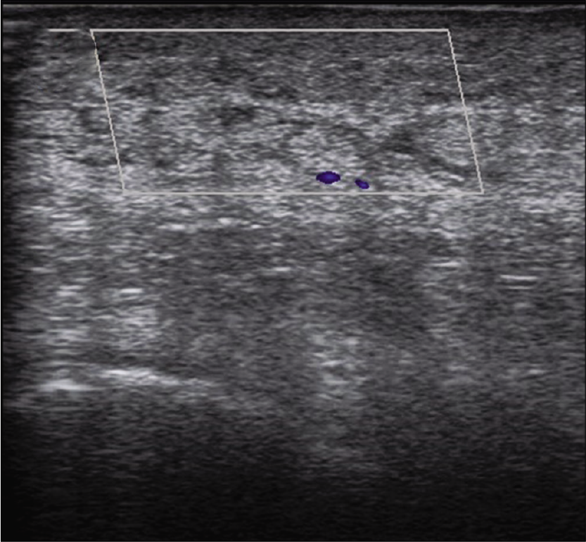 Increased blood flow was noted in color Doppler examination