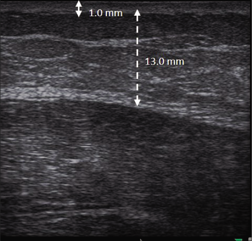 The thickness of the dermis and subcutaneous layer of the contralateral non-lesional area was 1.0 mm (solid double arrow line) and 13.0 mm (dotted double arrow line), respectively