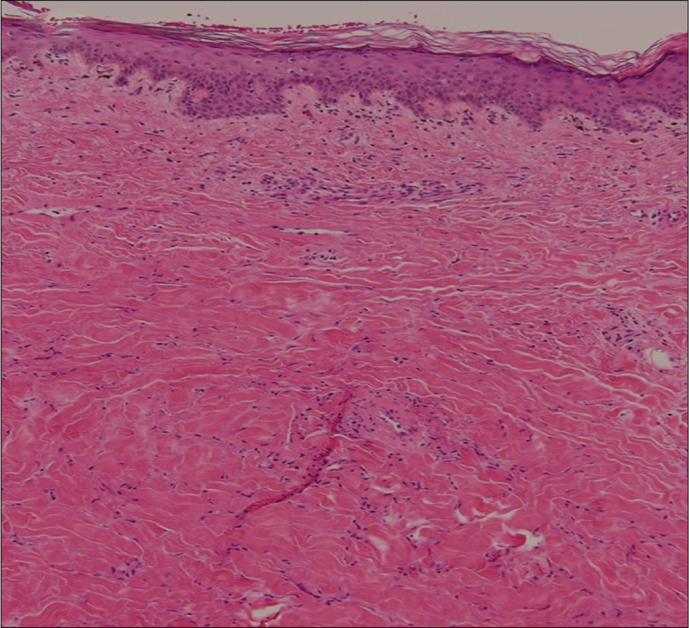 The histopathology showing melanin incontinence, dense compact sclerosis of the dermis, periadnexal and perivascular lymphocytic infiltration (H and E, ×100)