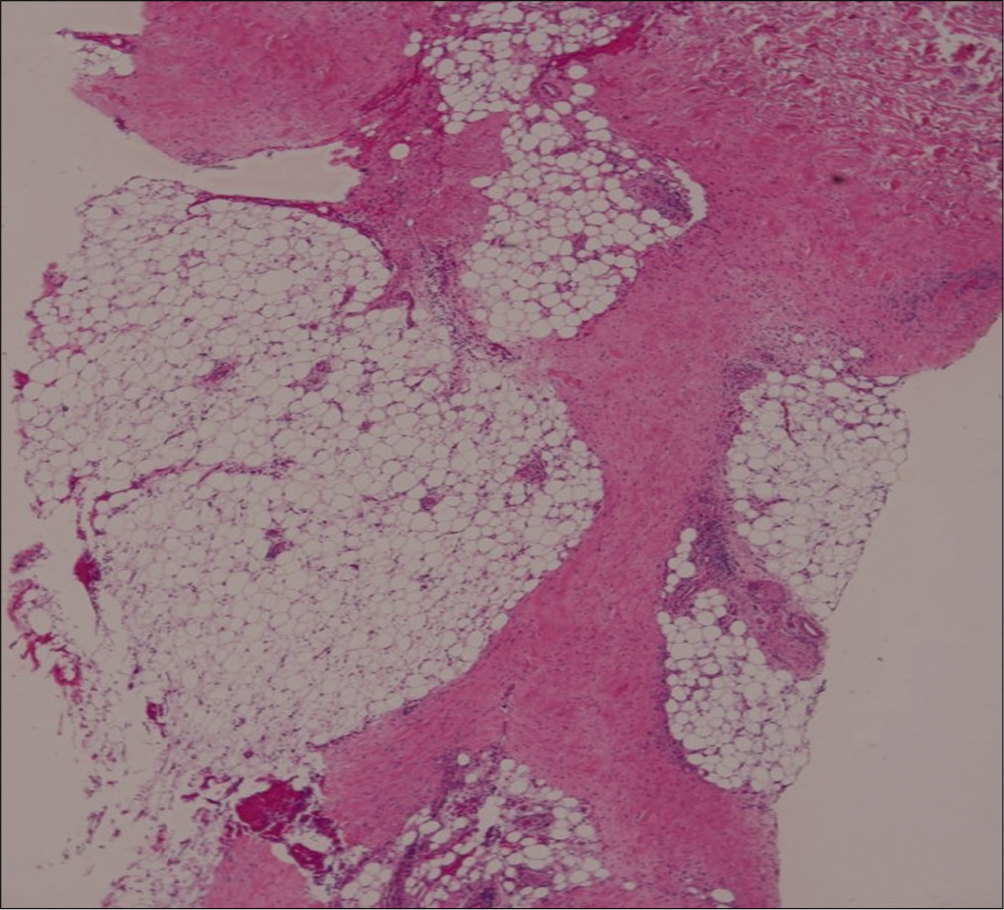 Marked septal fibrosis with lymphocytic infiltration in subcutaneous tissue (H and E, ×100)