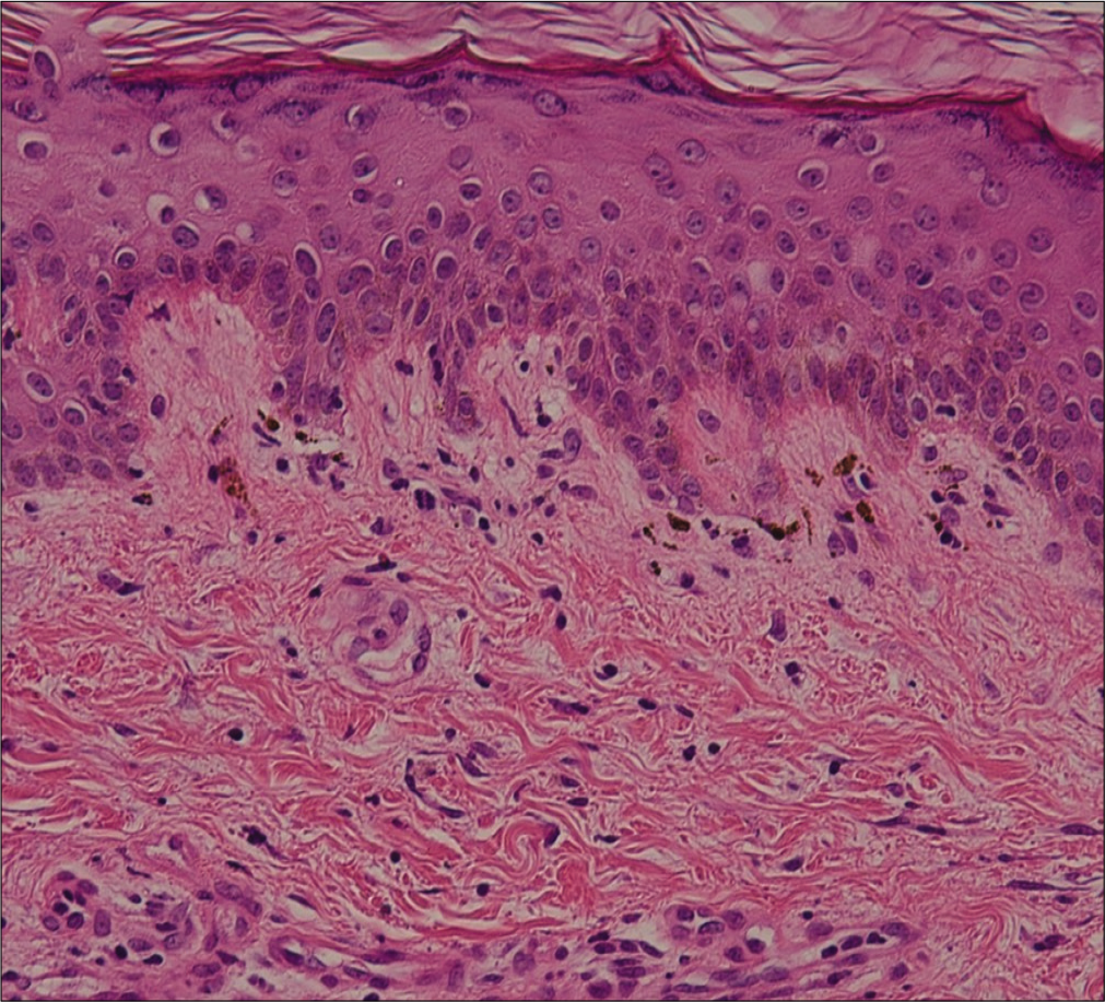 Melanin incontinence and thickened basement membrane. (H and E, ×400)