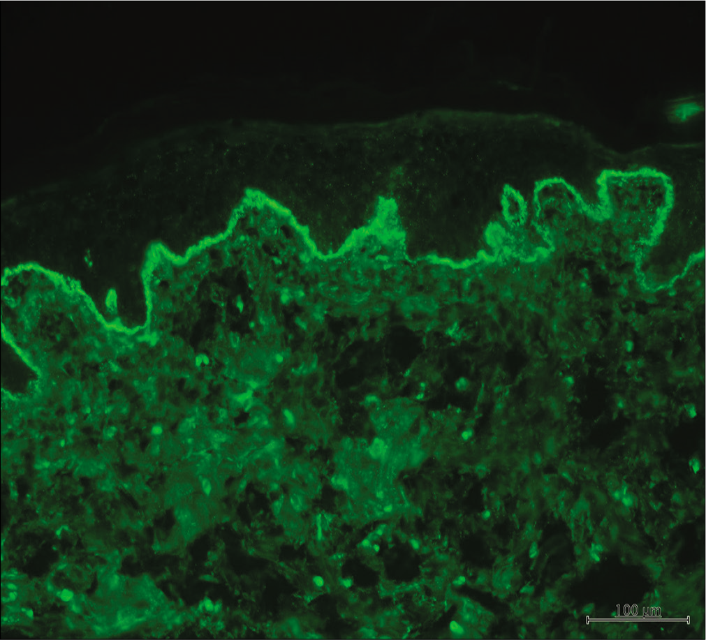 Lupus band test showing granular deposition of IgG at the dermo-epidermal junction