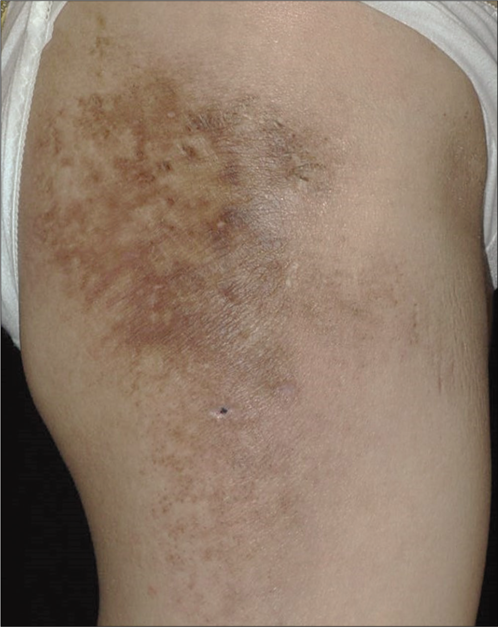 The erythema of skin lesions improved slightly after treatment for 2 months