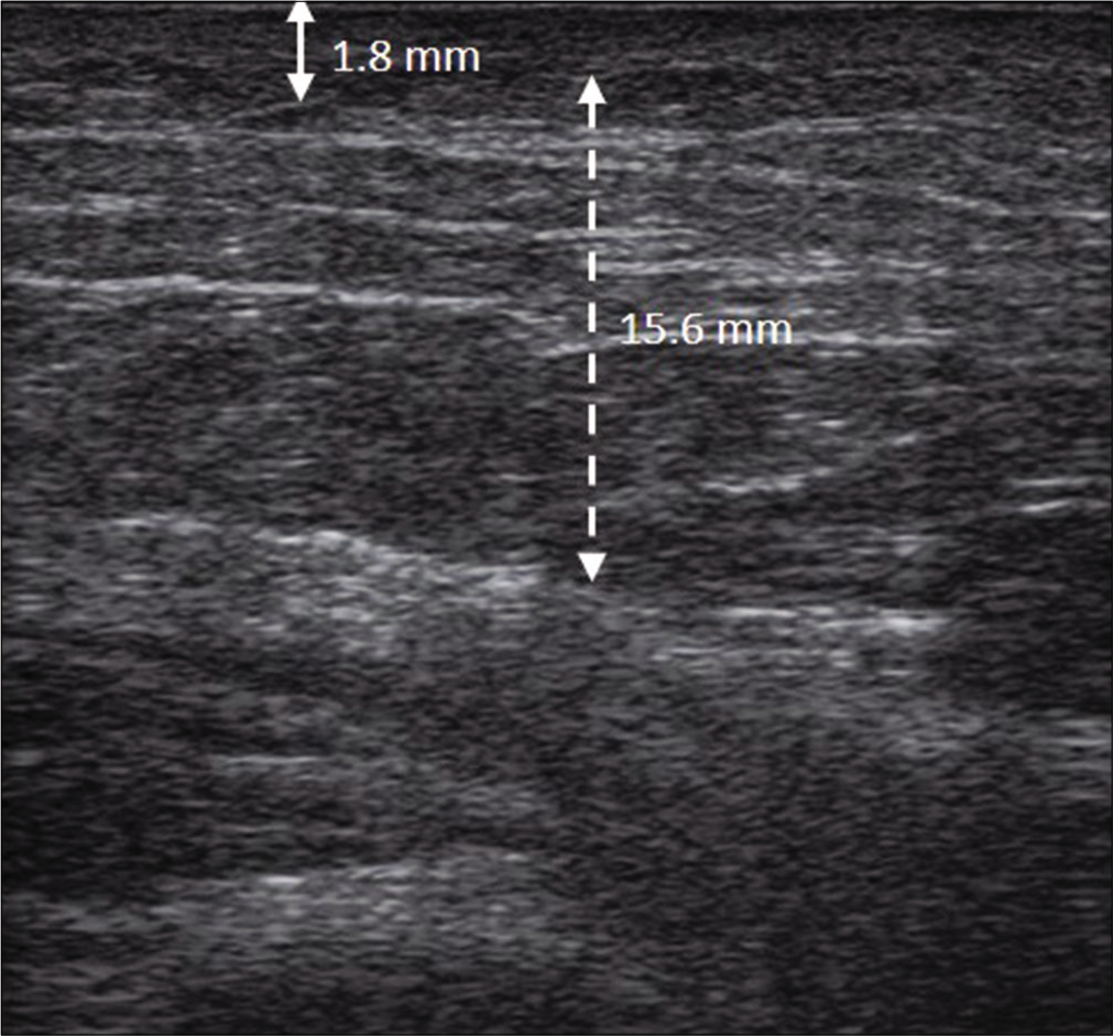 The thickness of dermis and subcutis were reduced to 1.8 mm (solid double arrow line) and 15.6 mm (dotted double arrow line), respectively, and the echogenicity was also reduced