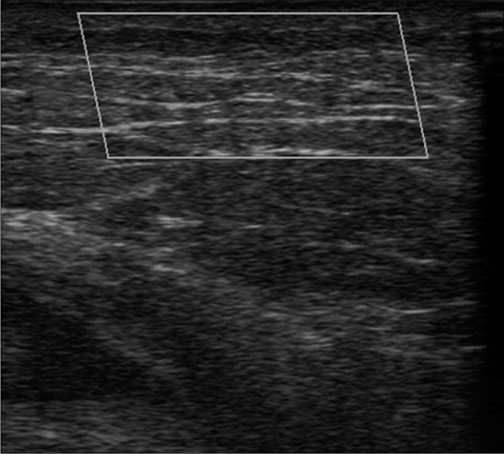 No increased blood flow was detected in the color Doppler examination