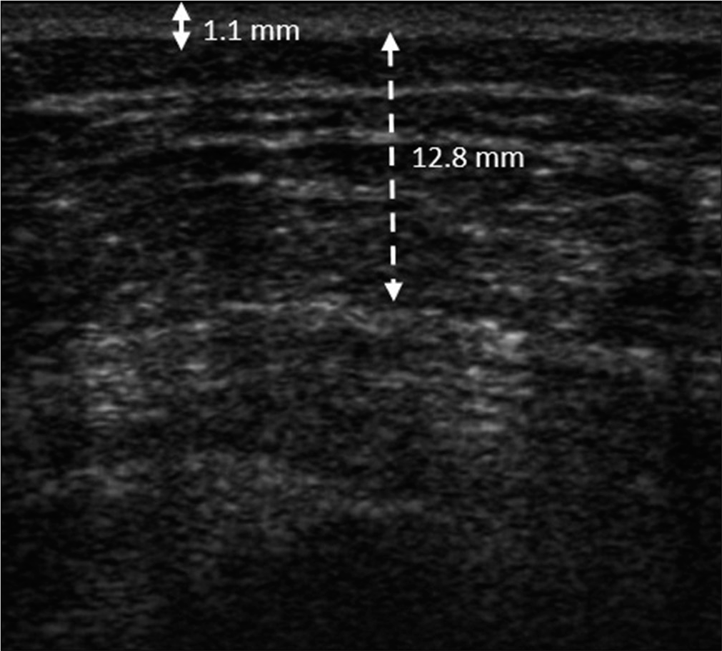 The thickness of the dermis and subcutaneous layer of the contralateral non-lesional area was 1.1 mm (solid double arrow line) and 12.8 mm (dotted double arrow line), respectively