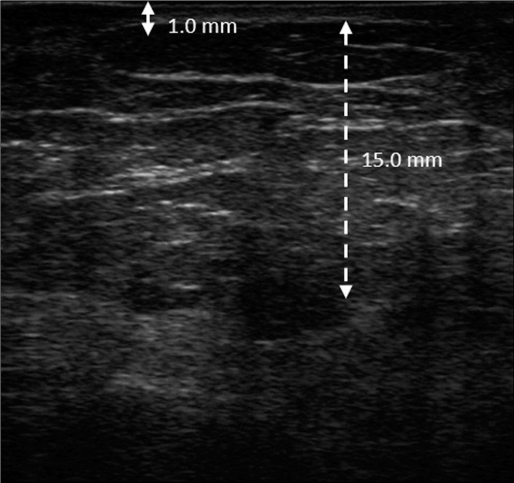 The thickness of dermis and subcutis were reduced to 1.0 mm (solid double arrow line) and 15.0 mm (dotted double arrow line), respectively, and the echogenicity returned to clear septate fat lobules