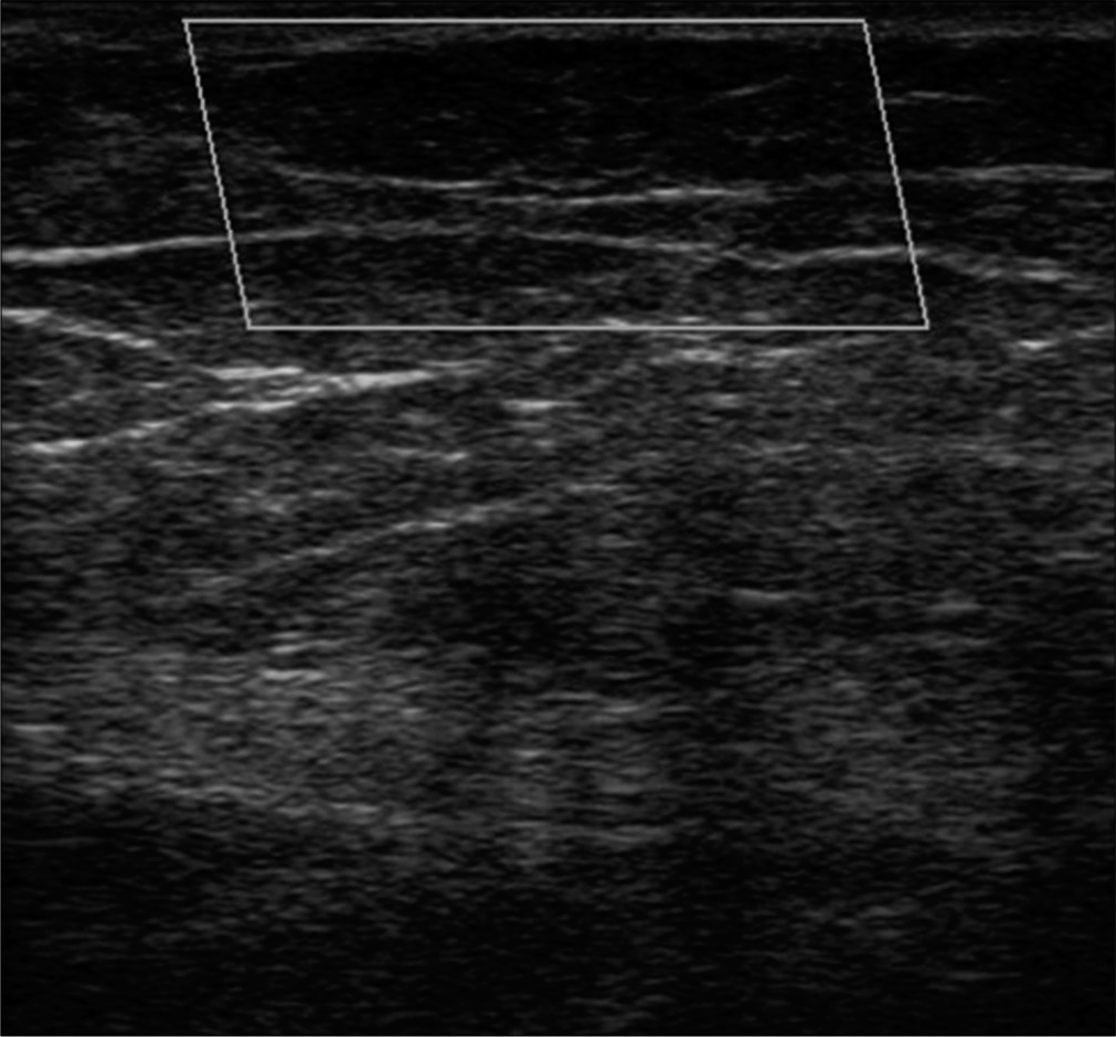 No increase in blood flow after treatment in color Doppler examination