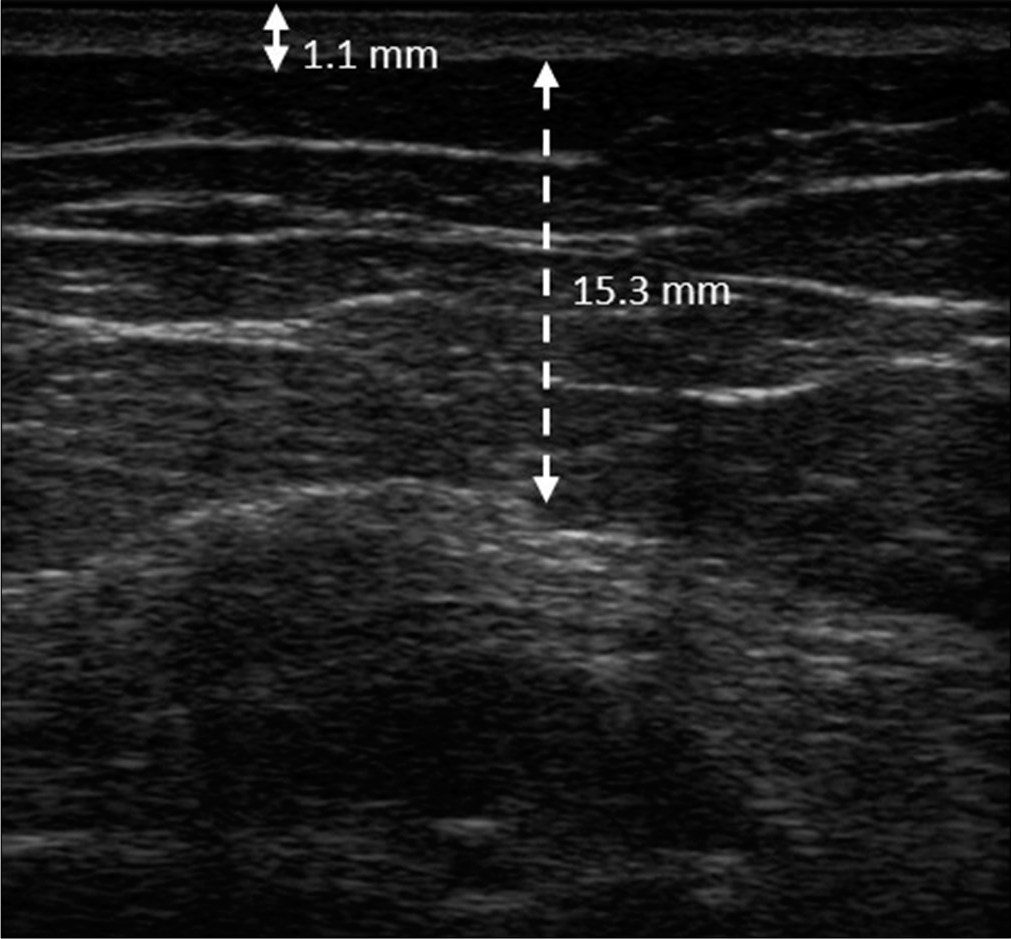 The thickness of the dermis and subcutaneous layer of the contralateral non-lesional area was 1.1 mm (solid double arrow line) and 15.3 mm (dotted double arrow line), respectively