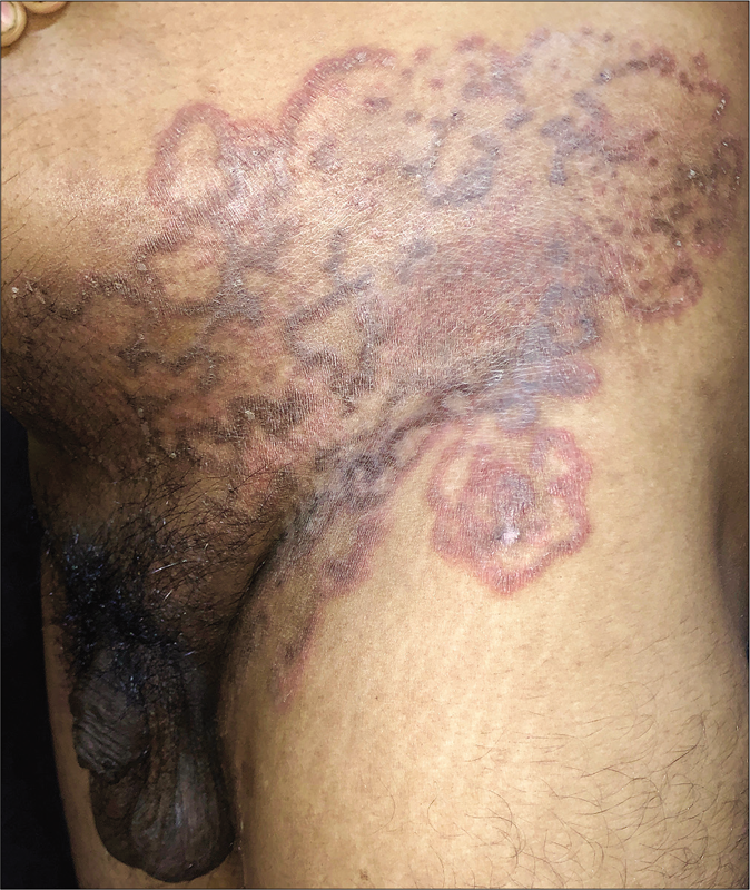 Multiple annular lesions coalescing to form a plaque