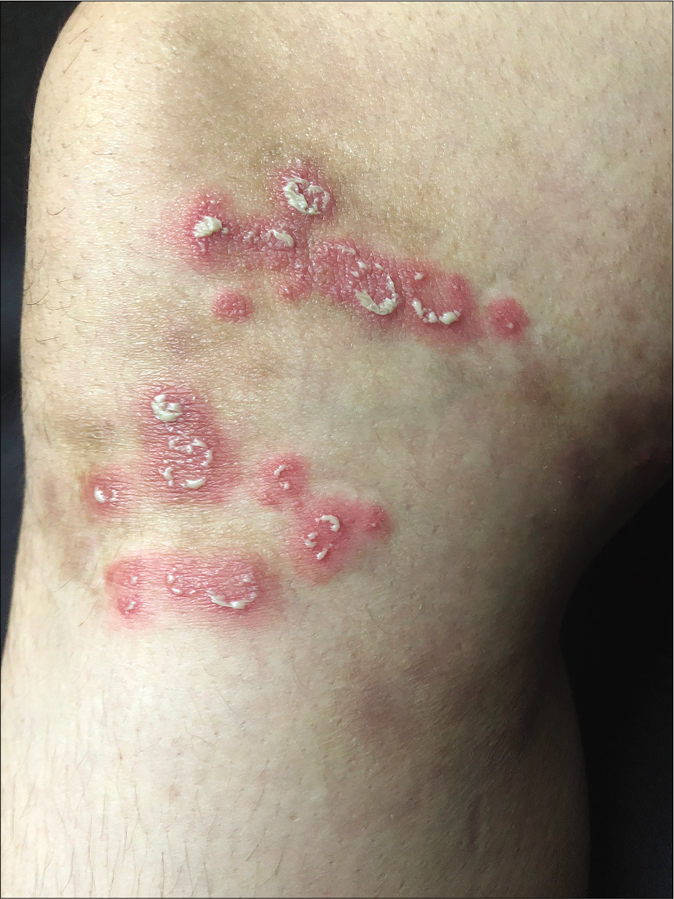 Multiple coalescing lesions with pustules