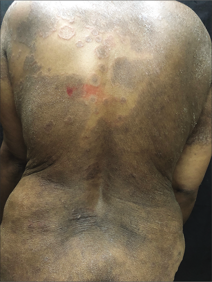 Erythrodermic variant of superficial dermatophytosis