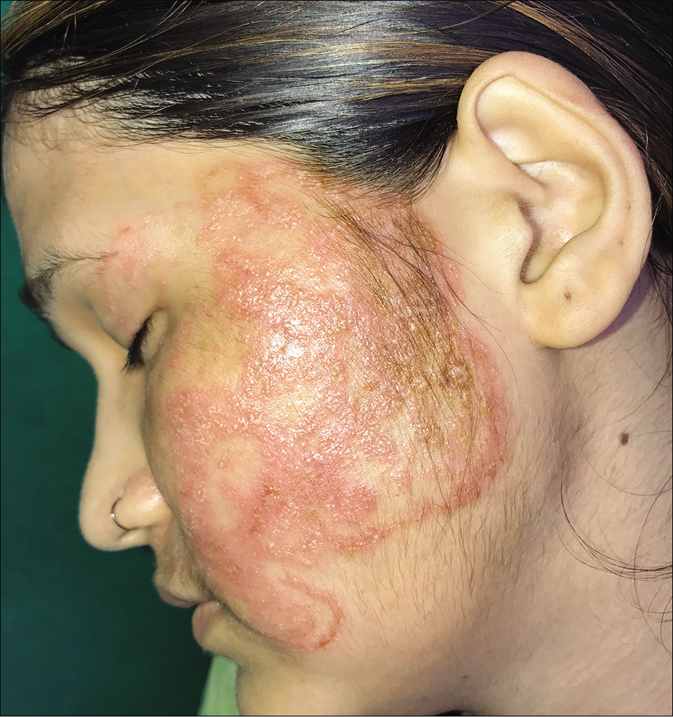 Eczematous variant of tinea facei