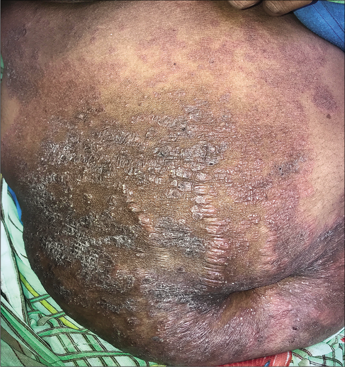 Eczematous variant of tinea corporis