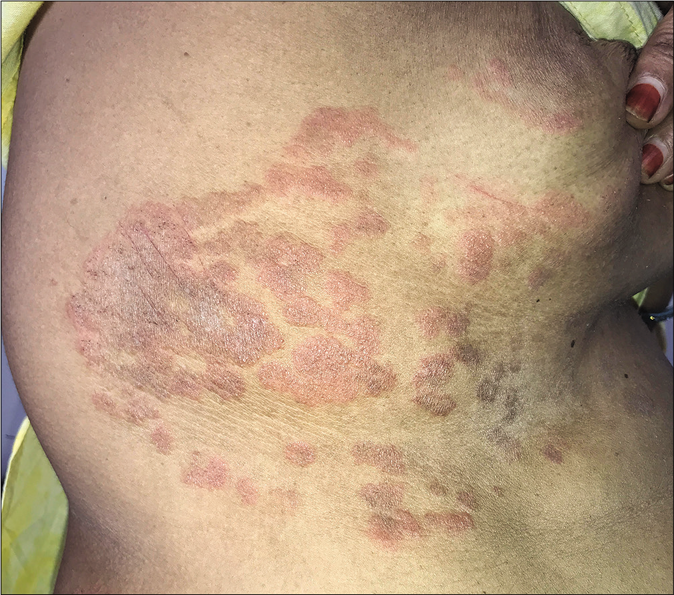 Tinea recidivans on upper torso