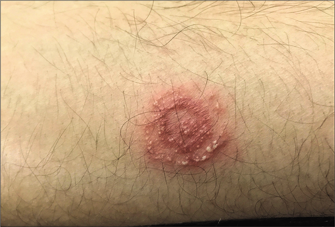 Cockade pattern of pustular lesions in steroid-modified tinea