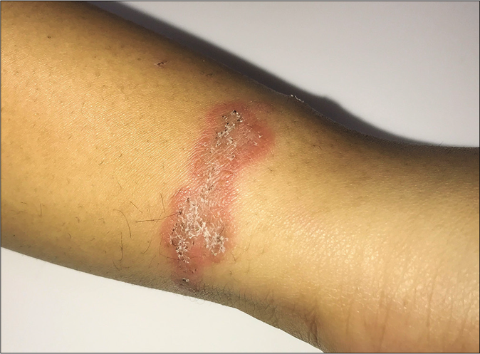 Tinea corporis limited to the area of occlusion by wrist band