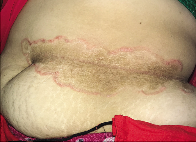 Tinea corporis presenting as a large annular plaque limited to the area of waistline along the line of occlusion by drawstring