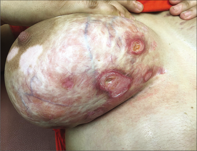 Steroid abuse in dermatophytosis leading to hypopigmentation, striae, atrophy, telangiectasia and ulceration