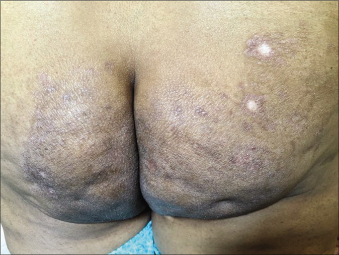 Depigmentation at the site of intralesional steroid injection