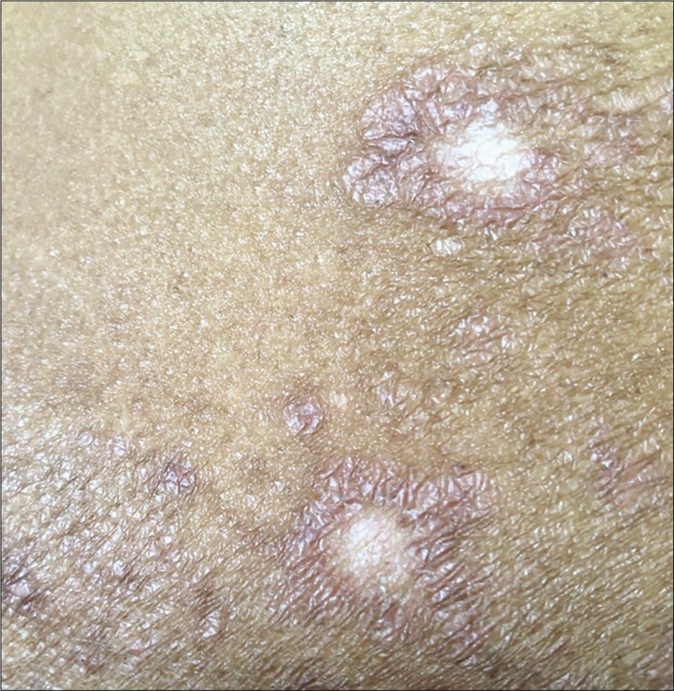 Close-up of depigmentation at the site of intralesional injection