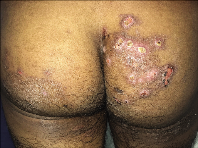 Superficial dermatophytosis with superadded bacterial infection