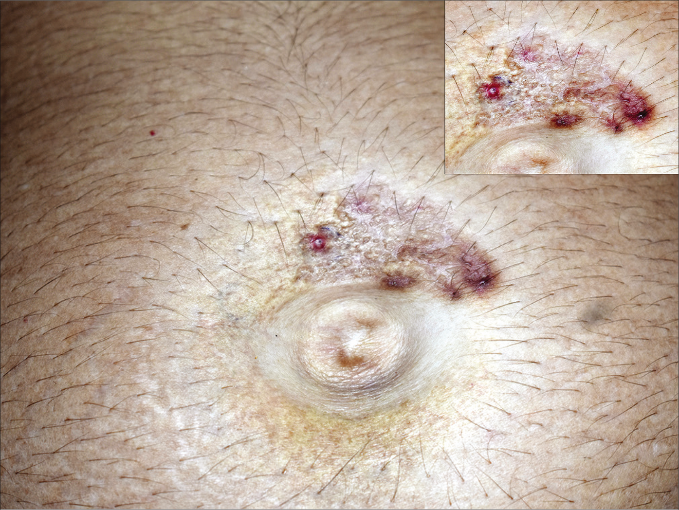 Yellowish papules coalescing to form a plaque around the umbilicus, with a few erythematous papules and scarring at the periphery. (Inset view) Erythematous keratotic papules, healing with depressed round-oval scars