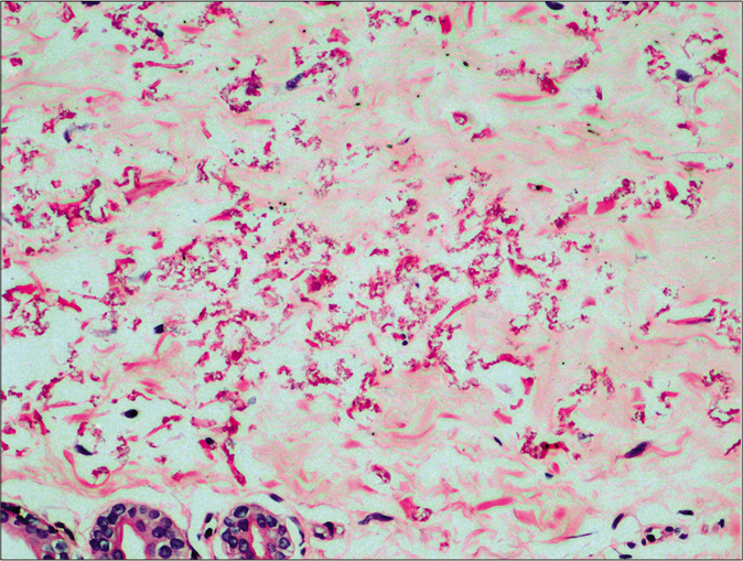 Histopathology from the yellowish plaque shows fragmented, curly elastin fibers in the reticular dermis (H and E, 200×)