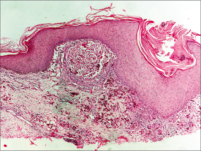 Biopsy of the keratotic papule shows transepidermal elimination of degenerated elastic fibres. (H and E, 40×)