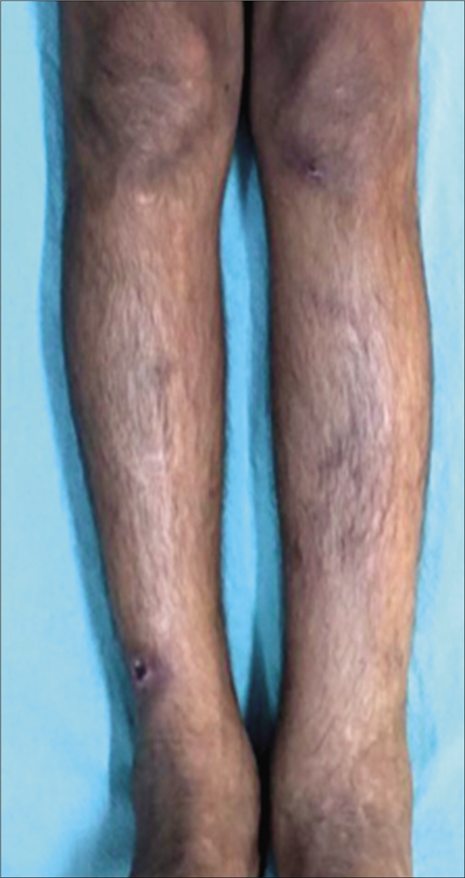 Edema of legs