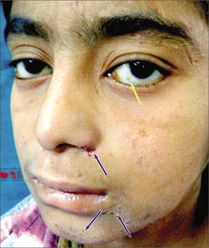 Bitot’s spots (Yellow arrow) with dry xerotic skin on the face (Blue arrow)