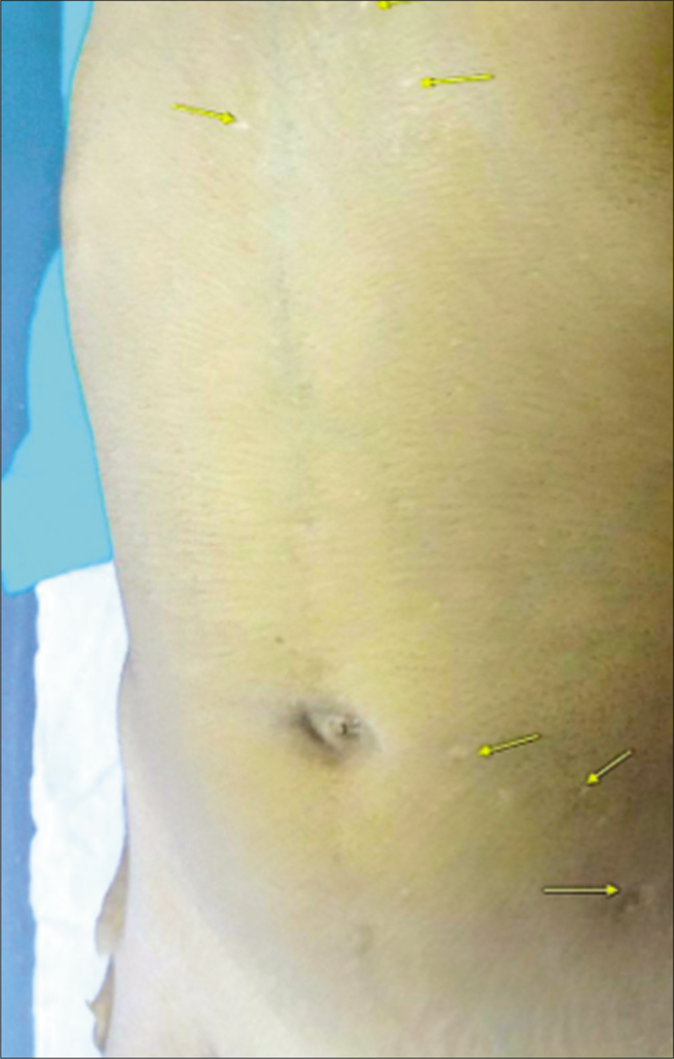 Atrophic scars on the body (yellow arrows)