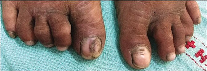 The great toe nails showed Beau’s line, brownish discoloration and onychorhexis