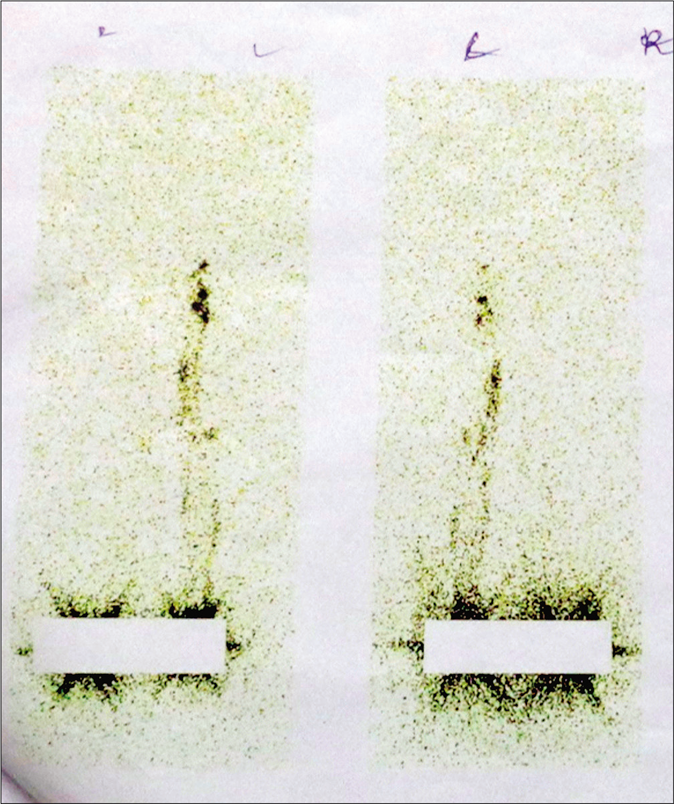 Lymphoscintigraphy of the legs showed dermal backflow at the left lower calf region on the left leg. On the right leg, there was no tracer movement and non-visualization of inguinal and femoral lymph nodes