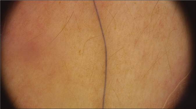 The image shows thick black hair under the skin without vasodilation (×20, polarized light)