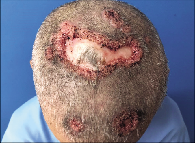 Multiple plaques with central atrophic scarring and numerous papules with pin point hemorrhages infiltrating the edges on the scalp