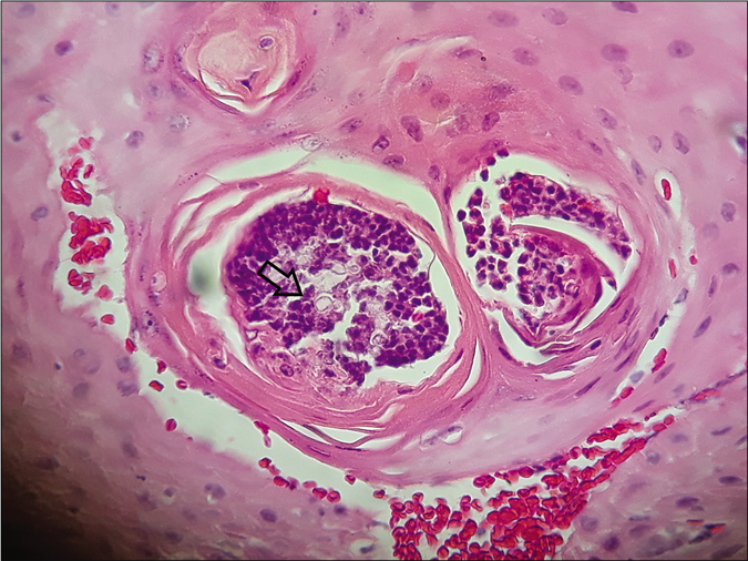 Multiple budding yeast cells (arrow) (hematoxylin and eosin, x400)